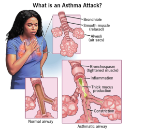 ASTHMA TREATMENT